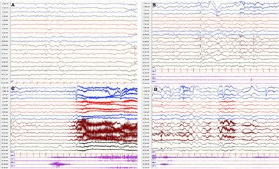 Case Report: A Case of Epileptic Disorder Associated With a Novel CNTN2 Frameshift Variant in Homozygosity due to Maternal Uniparental Disomy